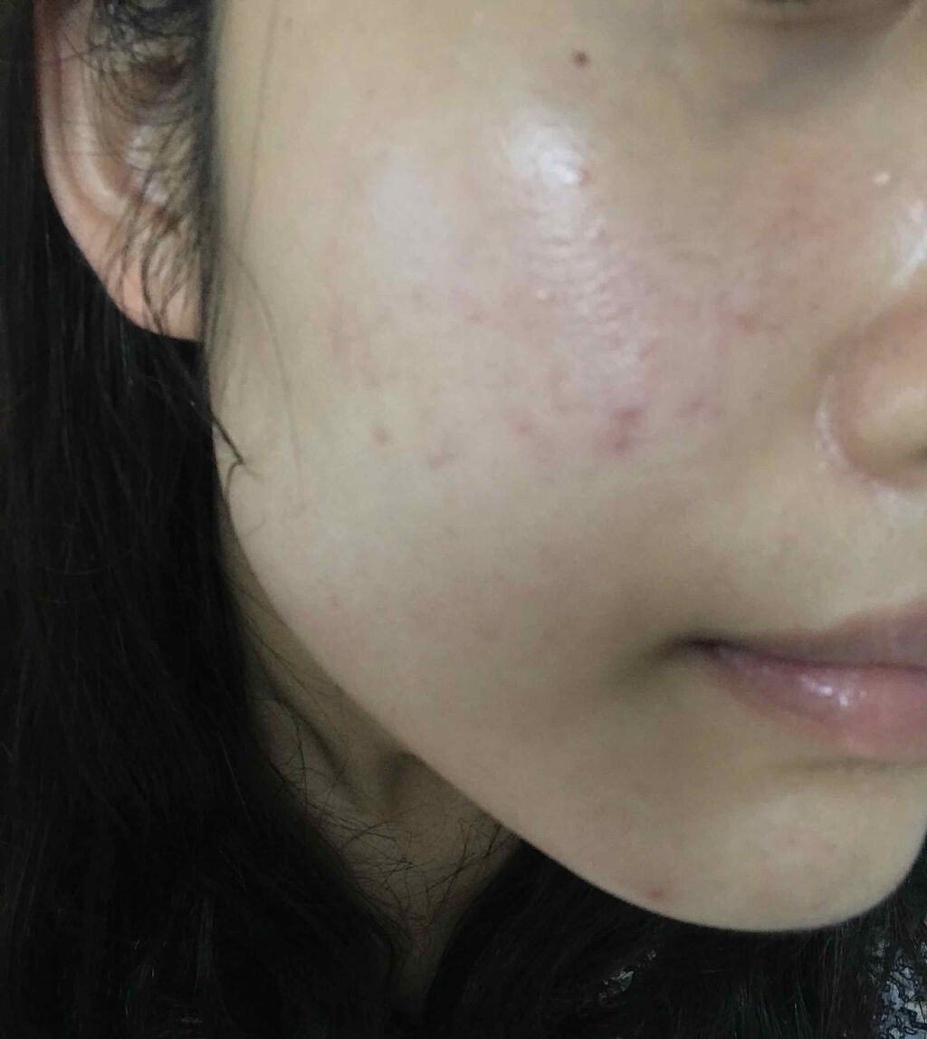 ペアアクネクリームW(医薬品)/ペア/その他を使ったクチコミ(1枚目)