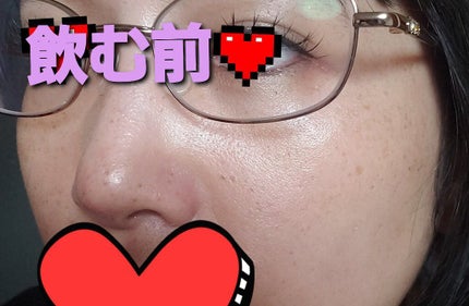 ホワイトCクリア(医薬品)/トランシーノ/その他を使ったクチコミ(2枚目)