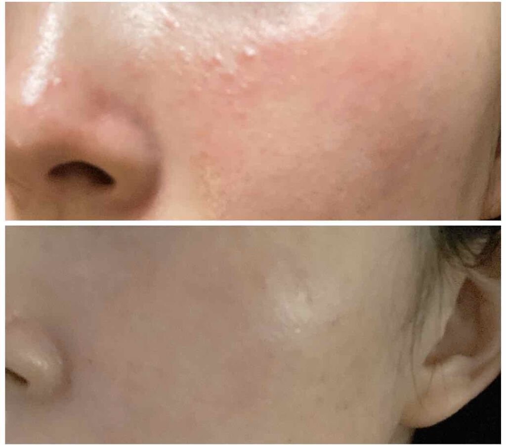 プリスクリードi（医薬品）/IHADA/その他を使ったクチコミ（2枚目）