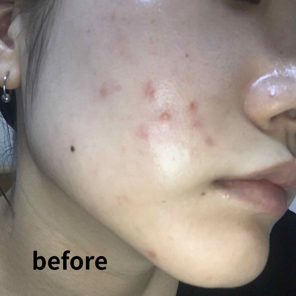 ペアアクネクリームW(医薬品)/ペア/その他を使ったクチコミ(2枚目)