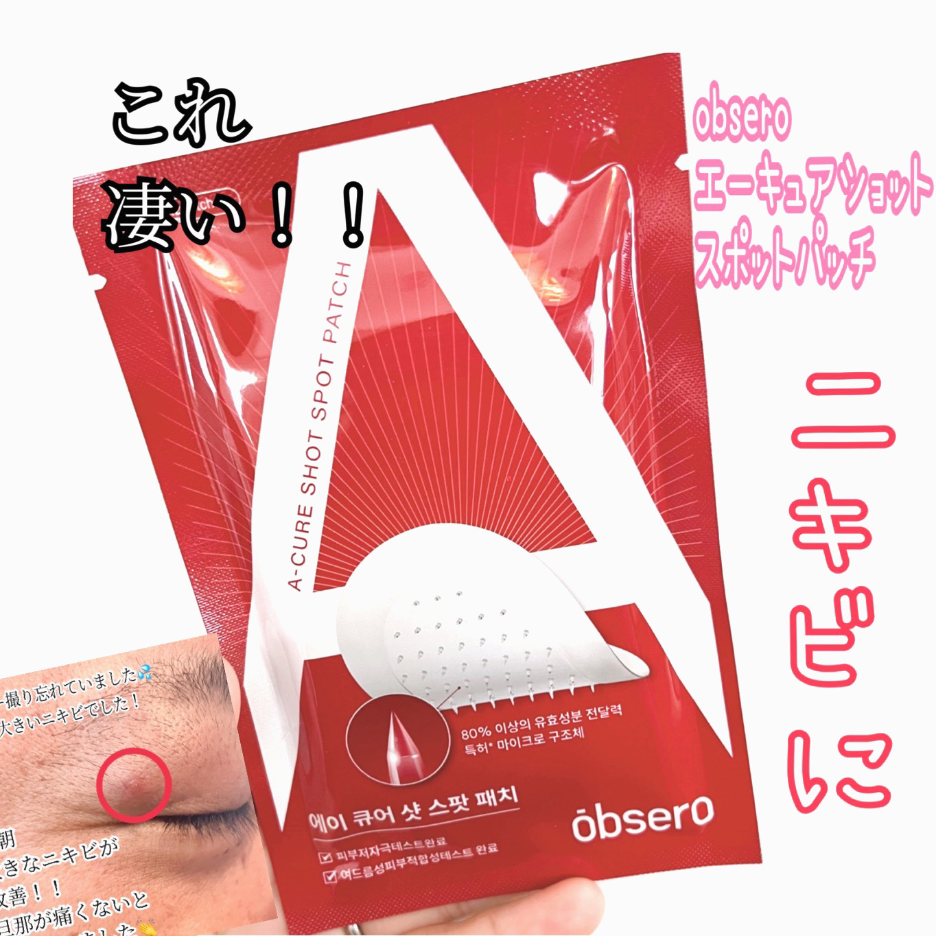 エーキュアショットスポットパッチ/obsero/にきびパッチを使ったクチコミ（1枚目）
