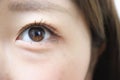 皮膚科医監修《目の周りが乾燥する原因と対策法》ワセリンやニベアなどおすすめクリームも