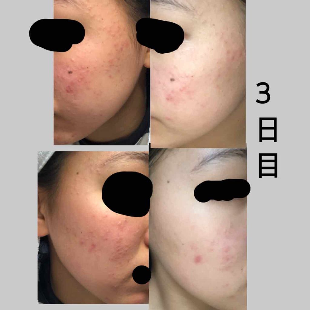 ワンステップオリジナルクリアパッド/COSRX/トナーパッドを使ったクチコミ(3枚目)