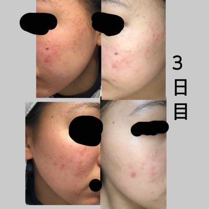 ワンステップオリジナルクリアパッド/COSRX/トナーパッドを使ったクチコミ(3枚目)