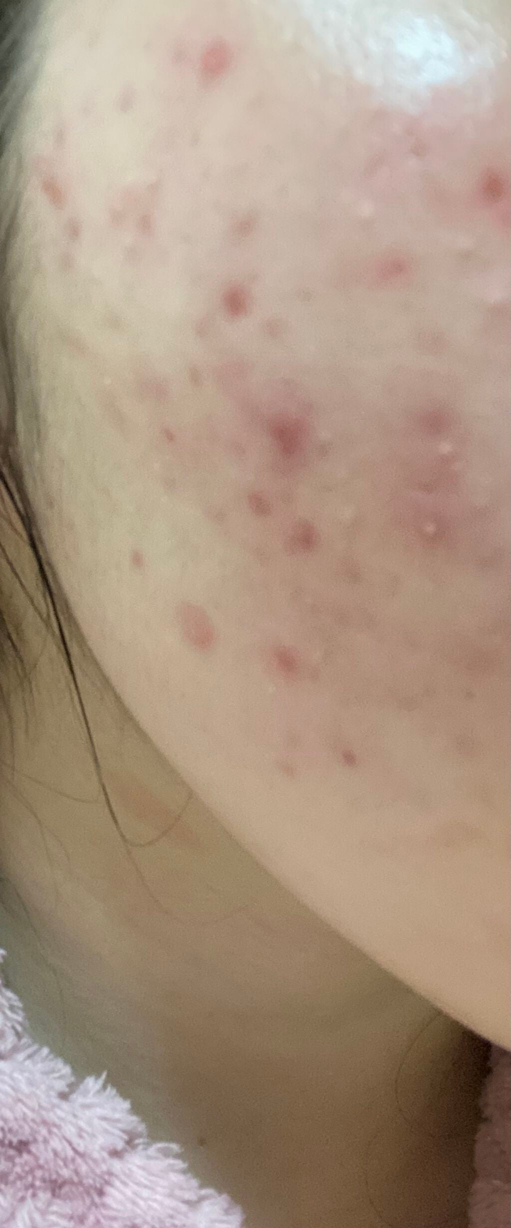 coral_cosme_z2c on LIPS 「皆さん助けてください😭😭ニキビ&ニキビ跡が治りません😓皮膚科に..」(1枚目)