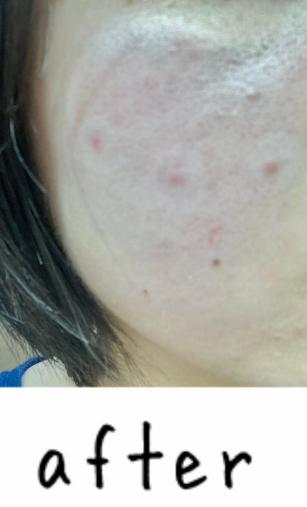 づめ on LIPS 「今回は、プロシカクリアスポットパッチをレビューします!プロシカ..」(4枚目)