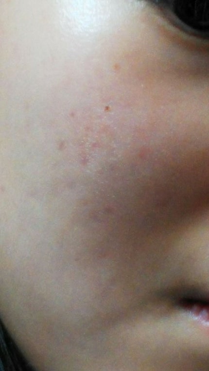 薬用 しみ 集中対策 美容液/メラノCC/美容液を使ったクチコミ(2枚目)