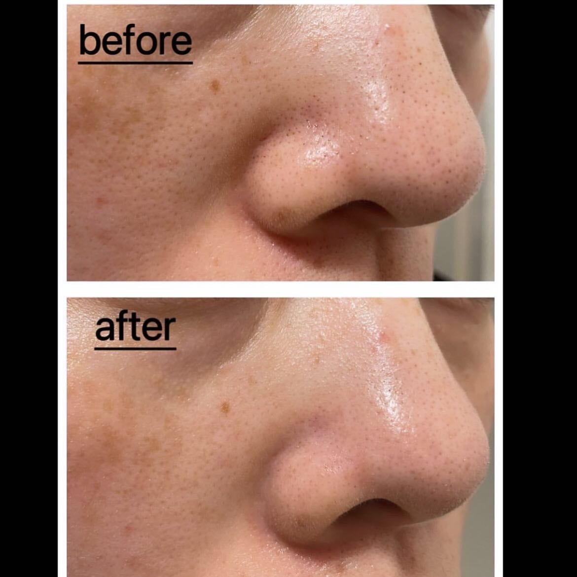 natsu on LIPS 「...超人気のクレンジングオイル@anua.jpさんの『ドクダ..」(4枚目)