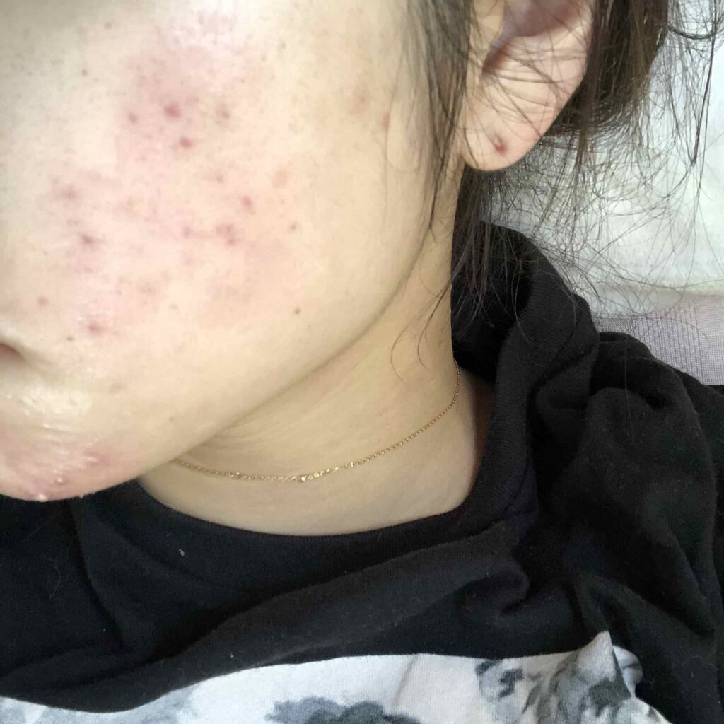 エピデュオゲル/マルホ株式会社/その他を使ったクチコミ（3枚目）