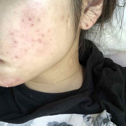 エピデュオゲル/マルホ株式会社/その他を使ったクチコミ(3枚目)