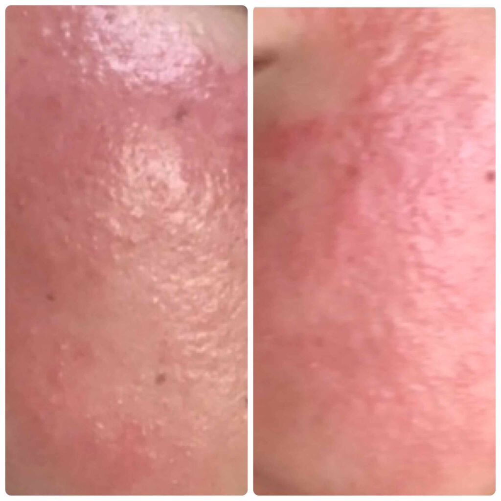 rin on LIPS 「ベピオゲル経過今、副作用に悩んでる方、ベピオゲルでの治療を検討..」(3枚目)