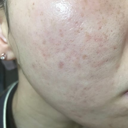 Azelaic Acid Suspension 10%/The Ordinary/美容液を使ったクチコミ(1枚目)