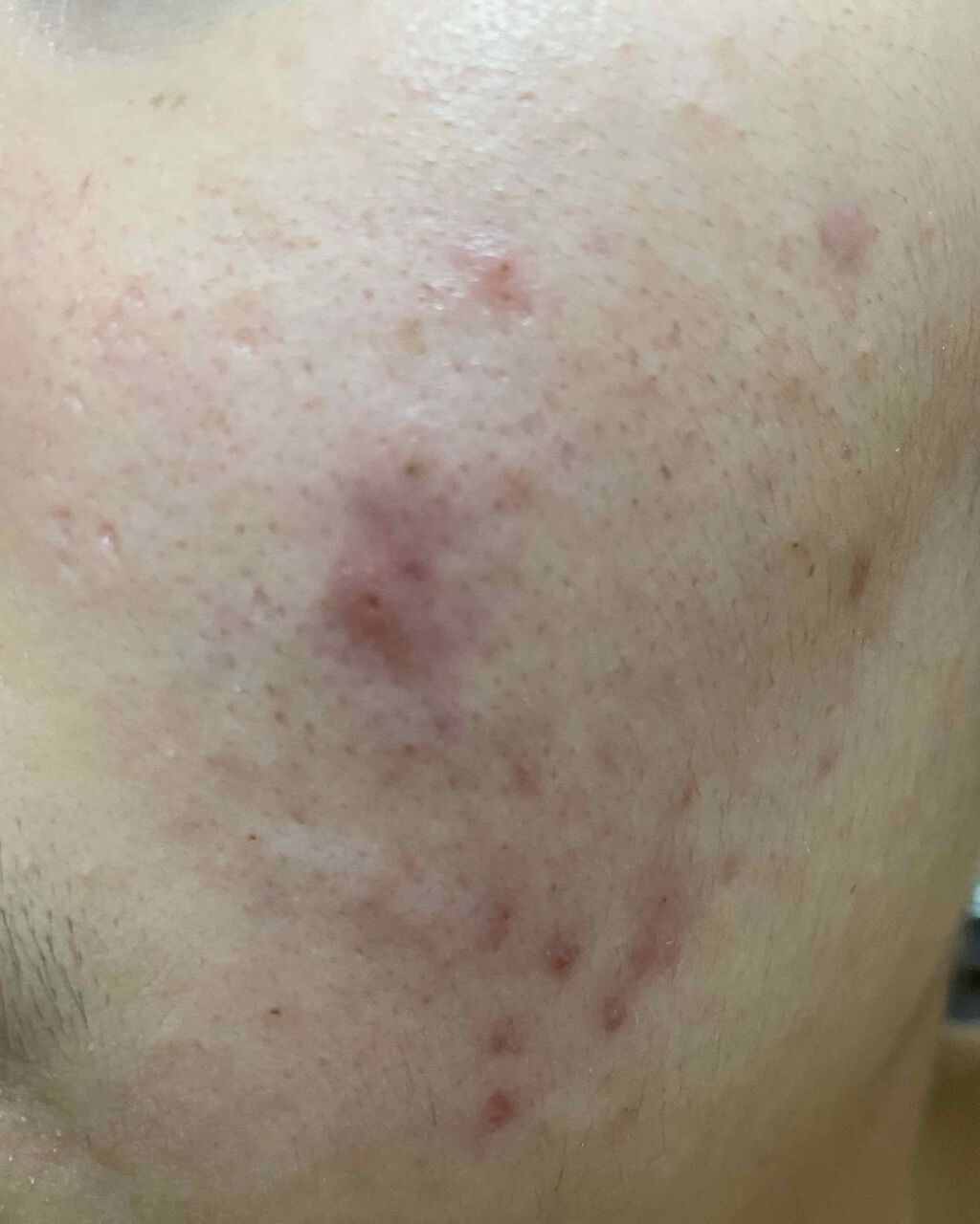 ACC パッチ/ETUDE/シートマスク・パックを使ったクチコミ（3枚目）