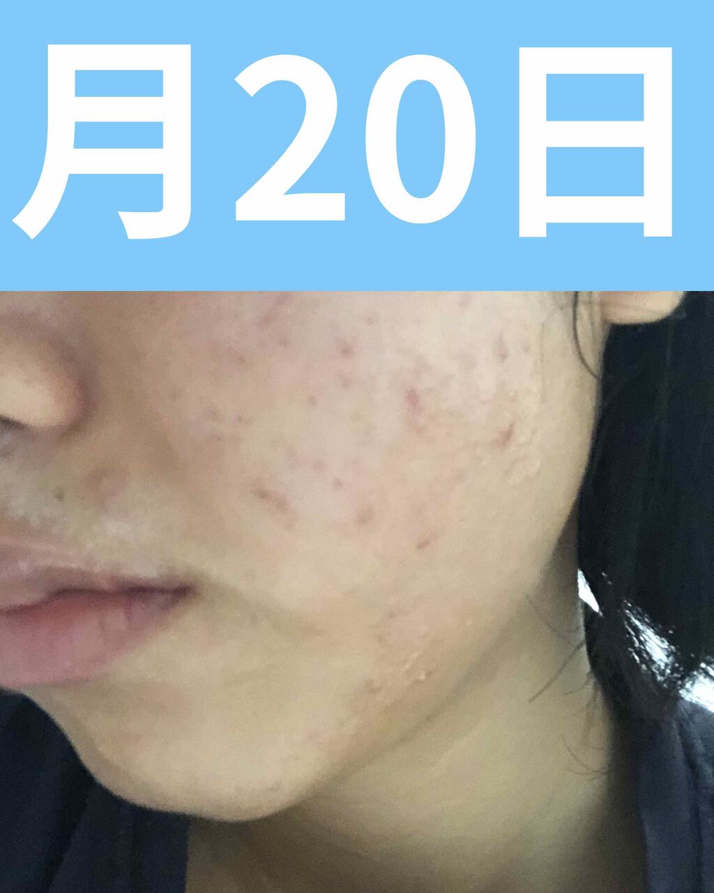 ペアアクネクリームW(医薬品)/ペア/その他を使ったクチコミ（3枚目）