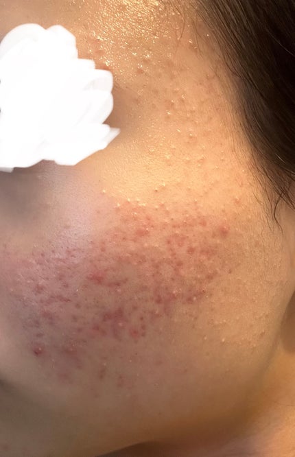 薬用しみ集中対策 プレミアム美容液/メラノCC/美容液を使ったクチコミ(2枚目)