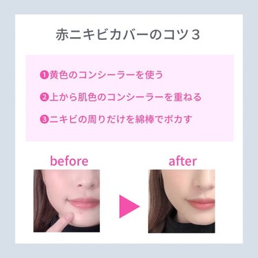 khimu(カイム) on LIPS 「赤ニキビの隠し方です☺️吹き出物というとか言わないとか🤔笑赤ニ..」（2枚目）