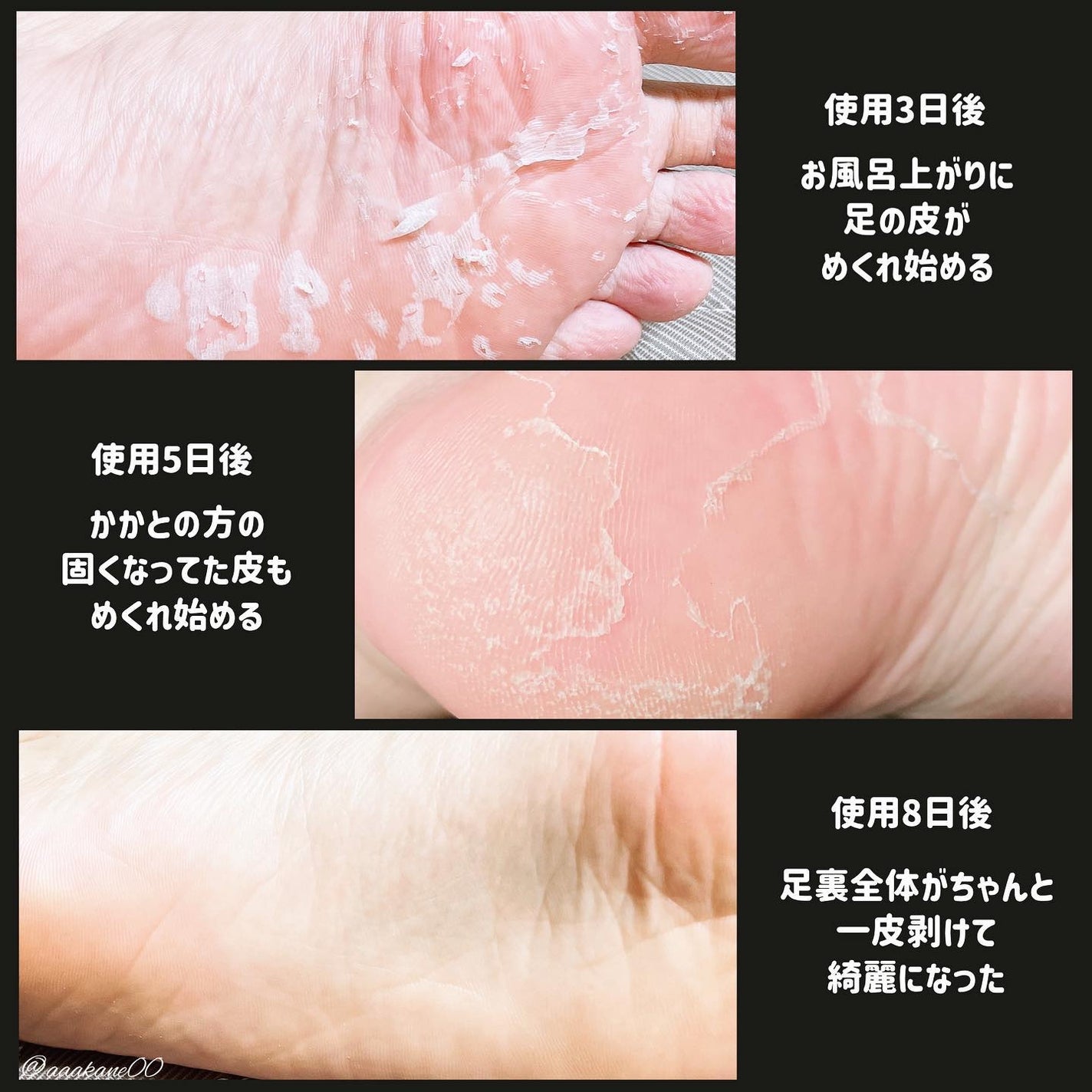 あしやすめ 足裏角質ケアパック/鎌倉ライフ/レッグ・フットケアを使ったクチコミ(4枚目)