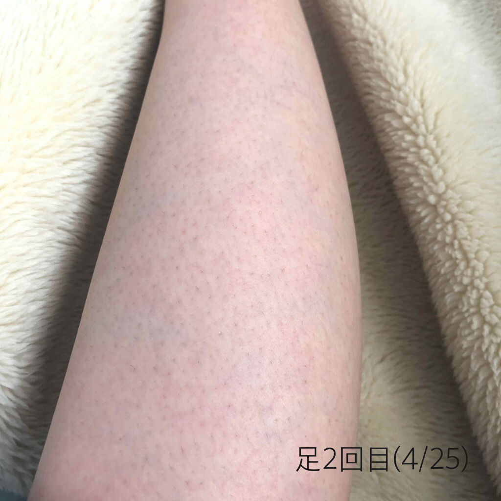 光美容器KE-NON（ケノン）/エムテック/家庭用脱毛器を使ったクチコミ（2枚目）