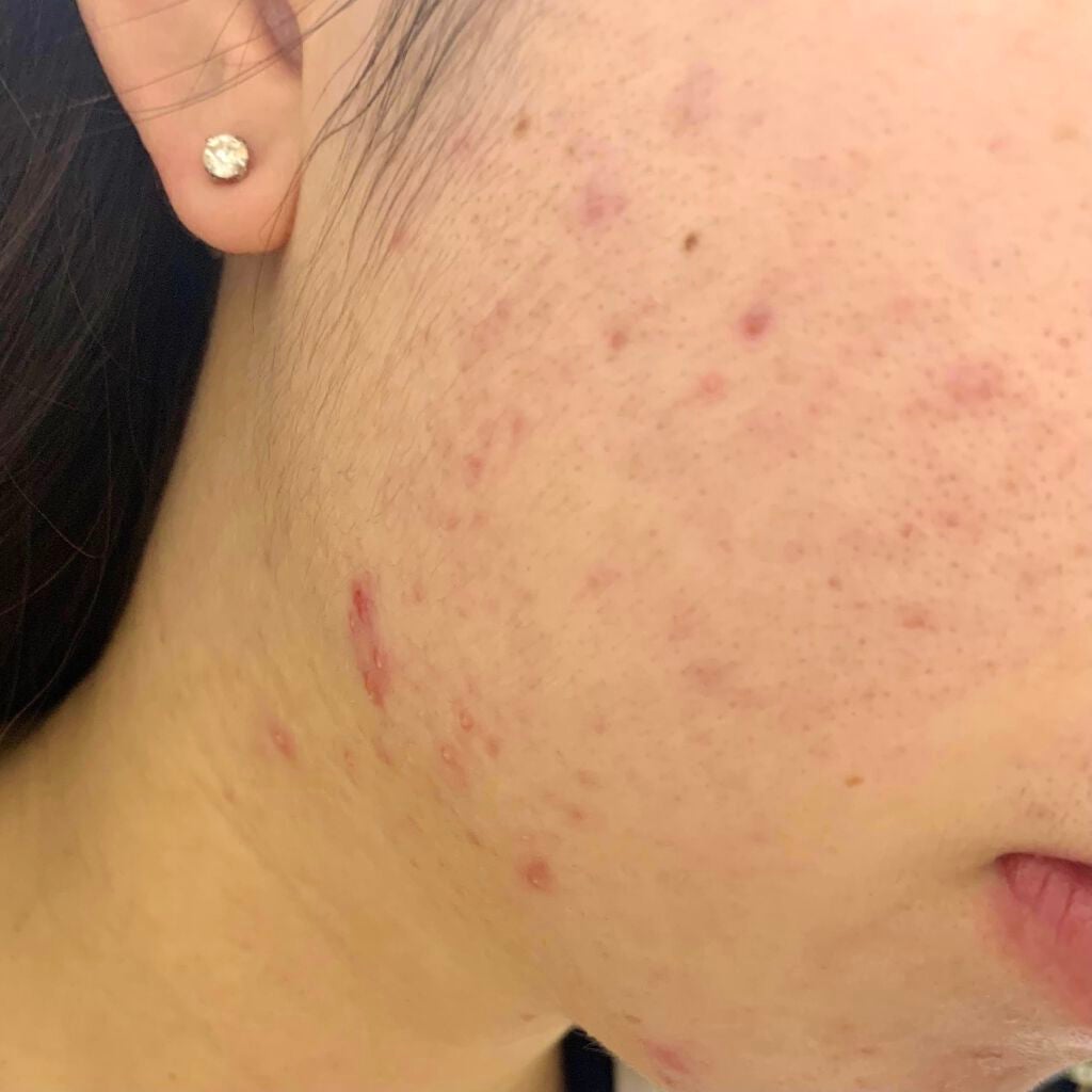 美容原液 オパール R-III/薬用 オパールR-Ⅲ/美容液を使ったクチコミ(4枚目)