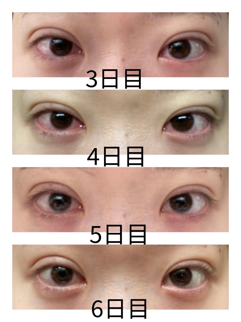 大福もち on LIPS 「念願だった二重整形をしてきました💖※1枚目は同じプリ機で撮影し..」(3枚目)