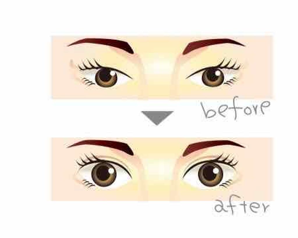 二重整形/その他を使ったクチコミ（1枚目）