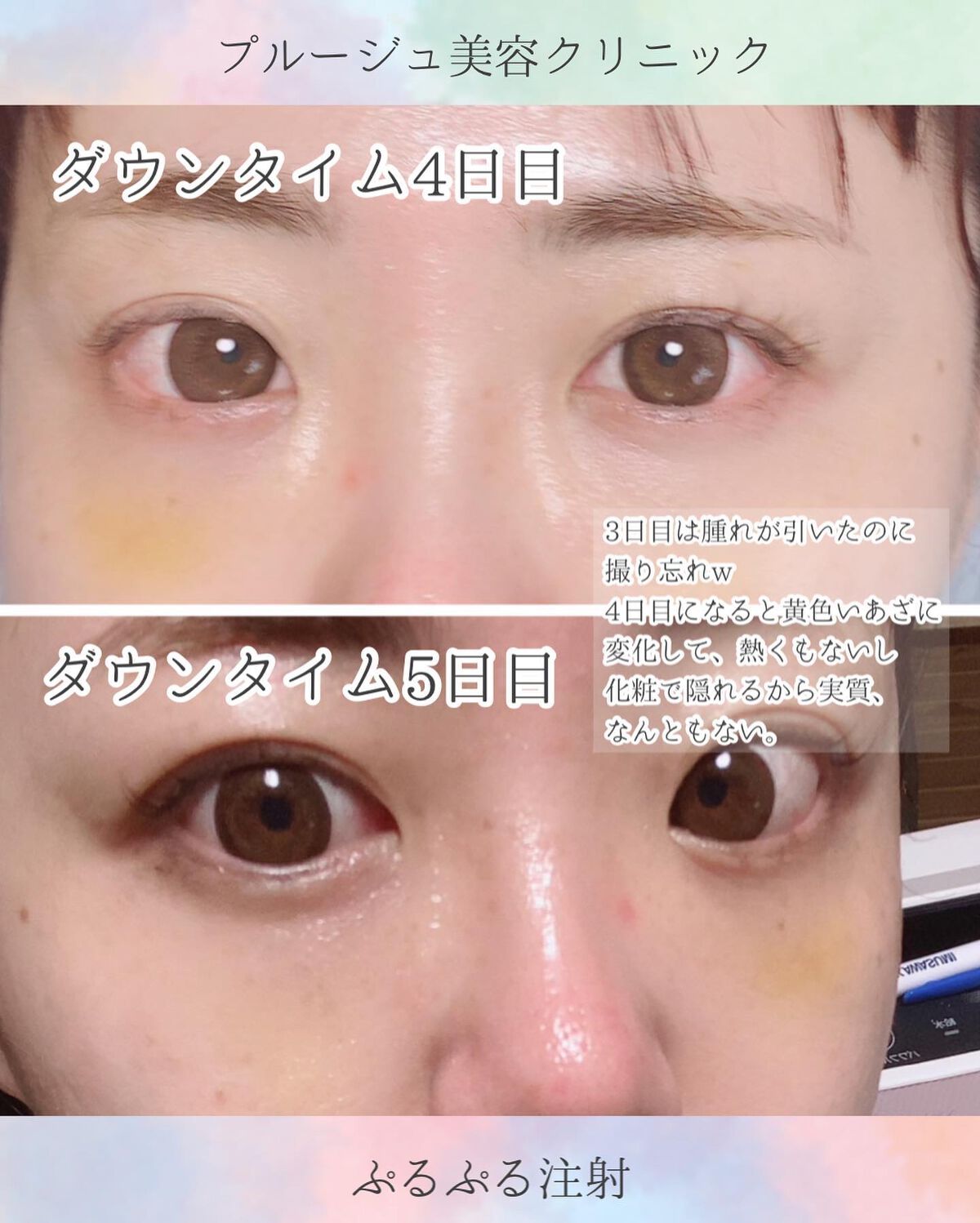 ちっちみ on LIPS 「*☂︎*̣̩⋆プルージュ美容クリニック(@pruge_clin..」(6枚目)