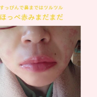 せいちゃん ☺️ Use up党♡ on LIPS 「肌荒れ大人ニキビ皮膚科行って薬飲んで塗って１ヶ月くらい経過しま..」（1枚目）