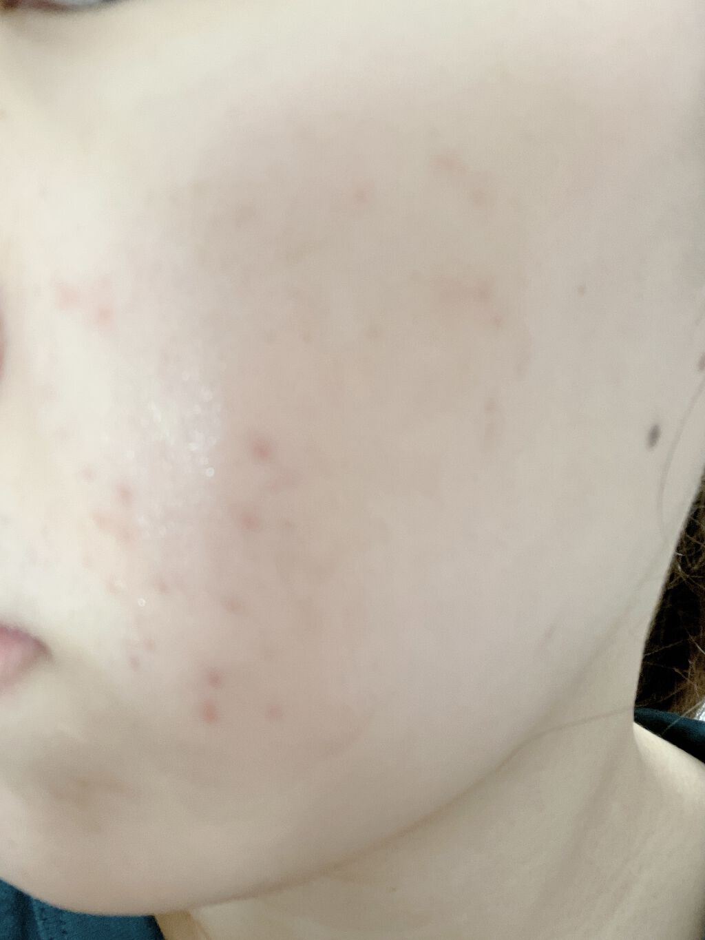 ニキビあとケアジェル/アットノン/その他スキンケアを使ったクチコミ（1枚目）