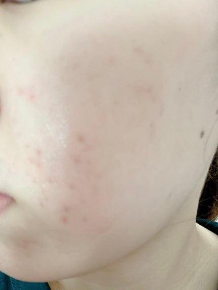 ニキビあとケアジェル/アットノン/その他スキンケアを使ったクチコミ(1枚目)