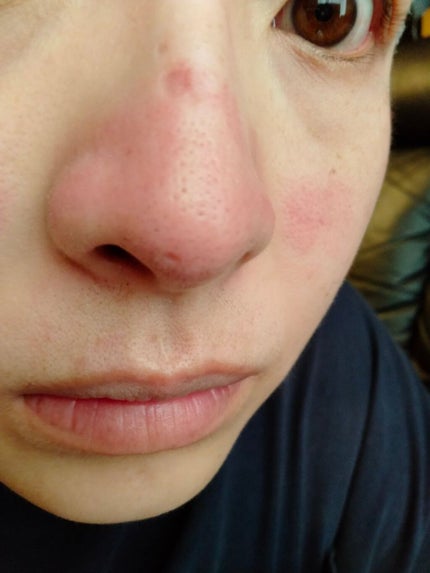 ダーマペン・ダーマスタンプ/MyM/その他スキンケアグッズを使ったクチコミ(2枚目)