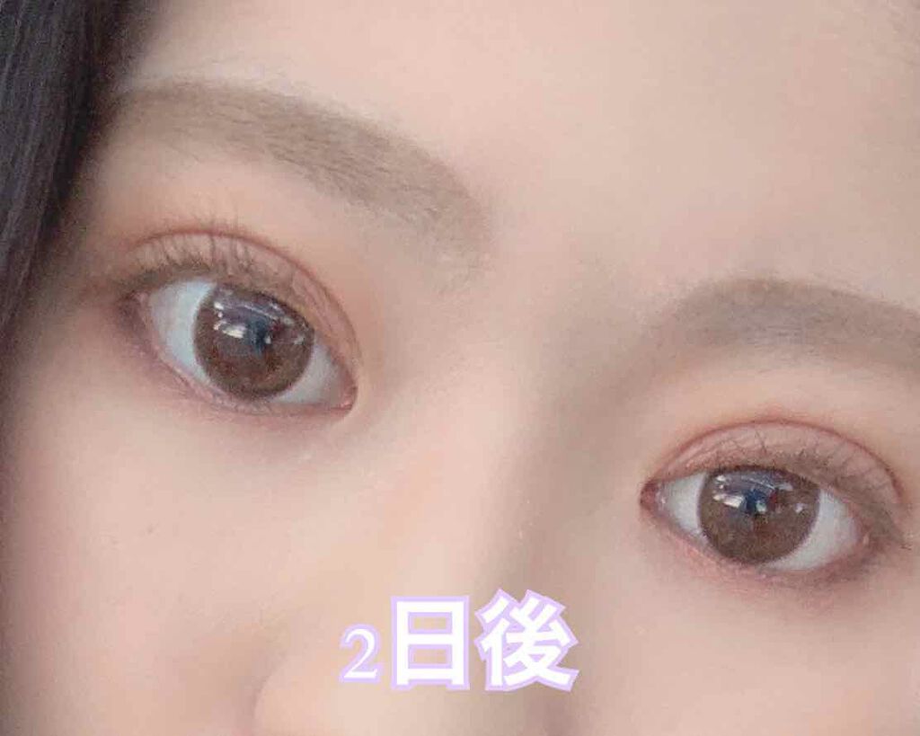 ITSUKI on LIPS 「私がやったクイックコスメティークダブルの二重施術は切らないタイ..」(2枚目)