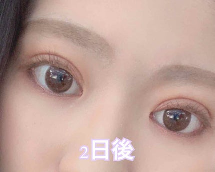 二重整形/その他を使ったクチコミ(2枚目)