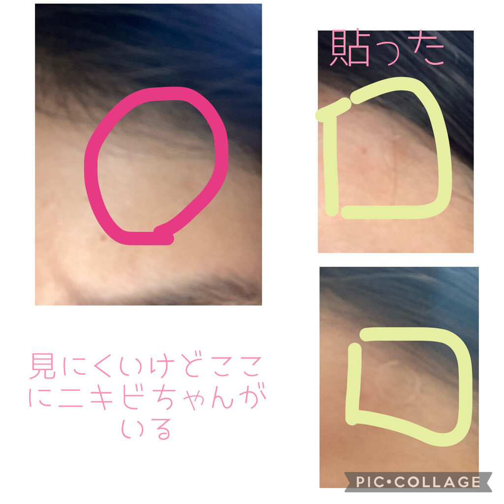 ゼロスポットパッチ/Today’s Cosme/にきびパッチを使ったクチコミ（3枚目）