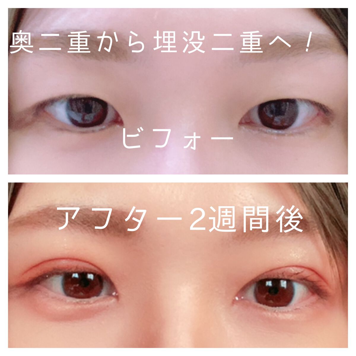 二重整形/その他を使ったクチコミ（1枚目）