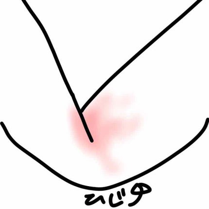 ベトネベートN軟膏AS(医薬品)/第一三共ヘルスケア/その他を使ったクチコミ(3枚目)