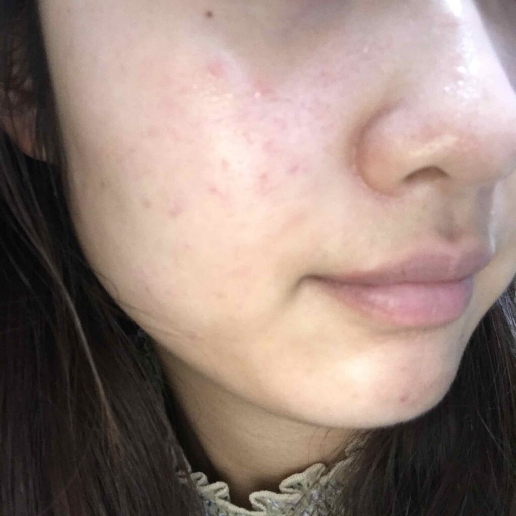 supreme_perfume_82i on LIPS 「・同じところにニキビ跡再発してる気がする・大きいニキビはそんな..」(1枚目)