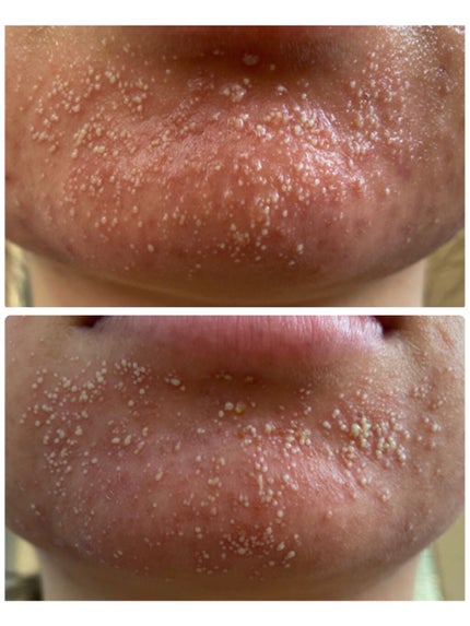 じんじゃー🫚 on LIPS 「2枚目、閲覧注意です合わない基礎化粧品でとんでもない事になって..」(3枚目)