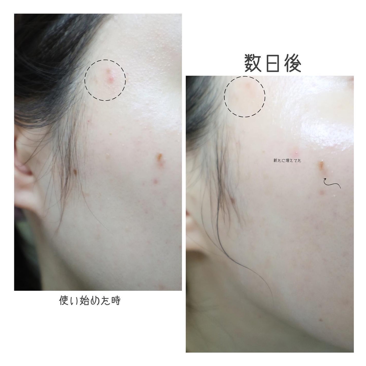 Meið on LIPS ãð»ãããæ©ã¿å¿
èŠð»ïŒïŒïŒãããèãããããè·¡â»ãŸã§ãã£ããã±ã¢..ãïŒ8æç®ïŒ