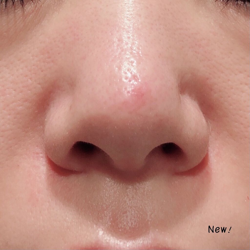 BEBETOXアンプルセット/YOU&ME/スキンケアキットを使ったクチコミ（2枚目）