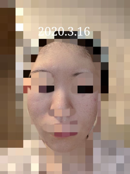 エバレッシュホワイトEXⅡ(医薬品)/matsukiyo/その他を使ったクチコミ(1枚目)