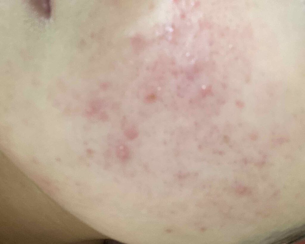 おからちゃん on LIPS 「2枚目から閲覧注意!!緊急事態です。もう全然治らないこのニキビ..」(3枚目)