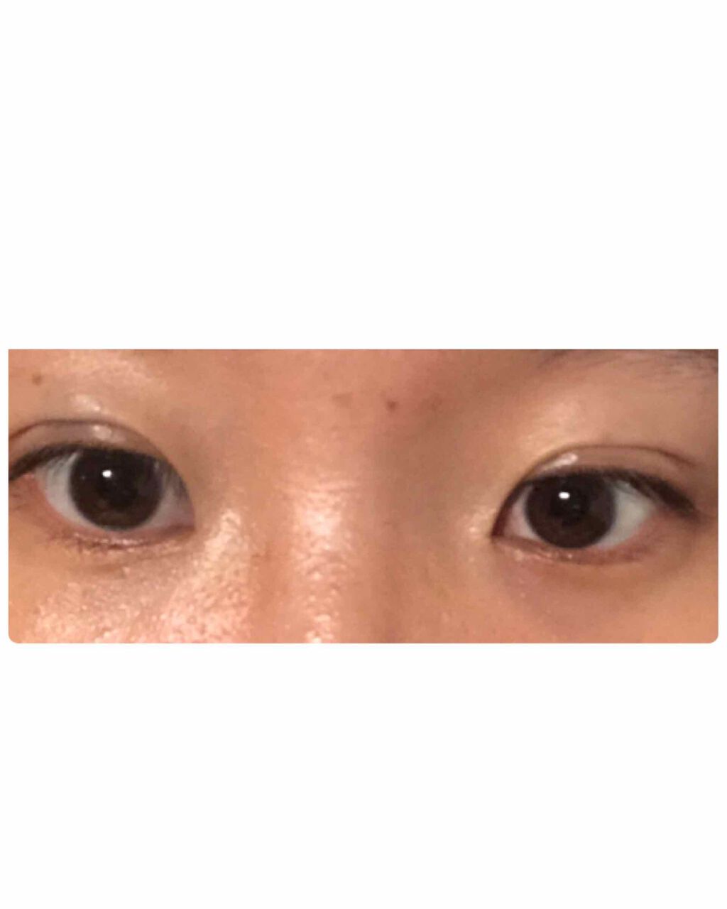 二重整形/その他を使ったクチコミ（2枚目）