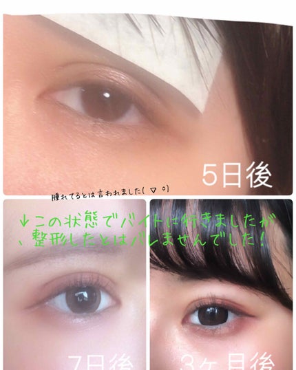 のびーるアイテープ(絆創膏タイプ、レギュラー)/DAISO/二重まぶた用アイテムを使ったクチコミ(4枚目)