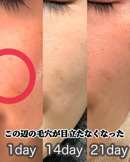 ビタペアC ビタレチ美容液/ネイチャーリパブリック/美容液を使ったクチコミ(7枚目)