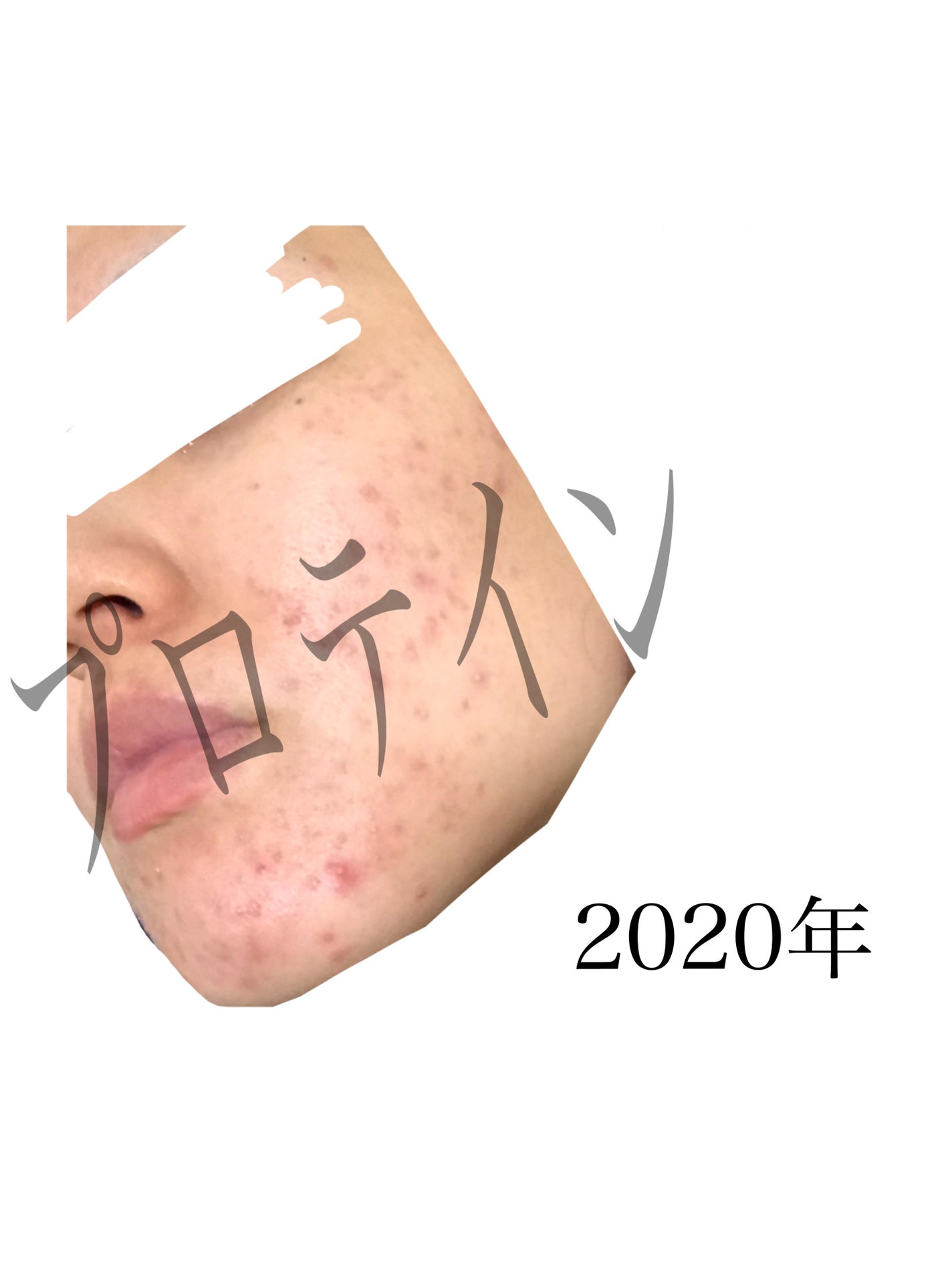 プロテイン on LIPS 「【自分用メモ】肌荒れでしんどい時読めいつかの私ほら!過去からこ..」(4枚目)