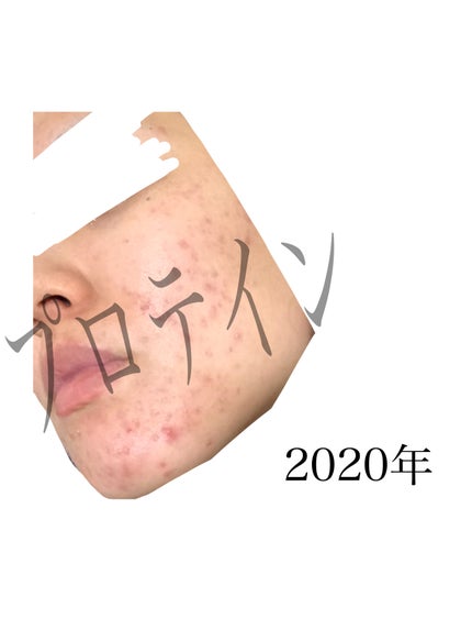 プロテイン on LIPS 「【自分用メモ】肌荒れでしんどい時読めいつかの私ほら!過去からこ..」(4枚目)