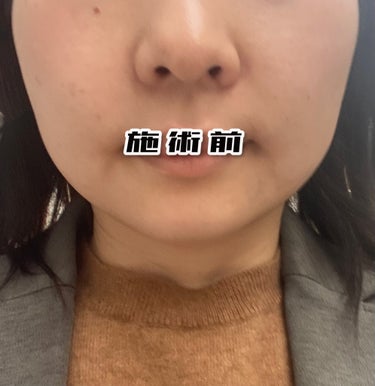 YUMI TIBI on LIPS 「加工無しの画像です!!閲覧ご注意ください!!本日も白玉注射を打..」（2枚目）