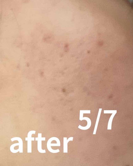 バイオイル/バイオイル/フェイスオイルを使ったクチコミ(3枚目)