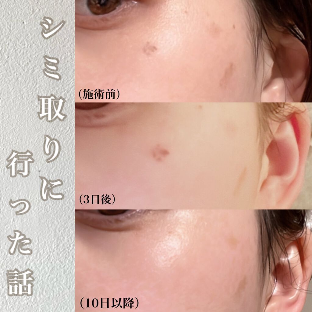薬用 しみ 集中対策 美容液 メラノccを使った口コミ どんなにメイクで誤魔化してもスキンケア頑張 By 羽華 フォロバ100 混合肌 代後半 Lips