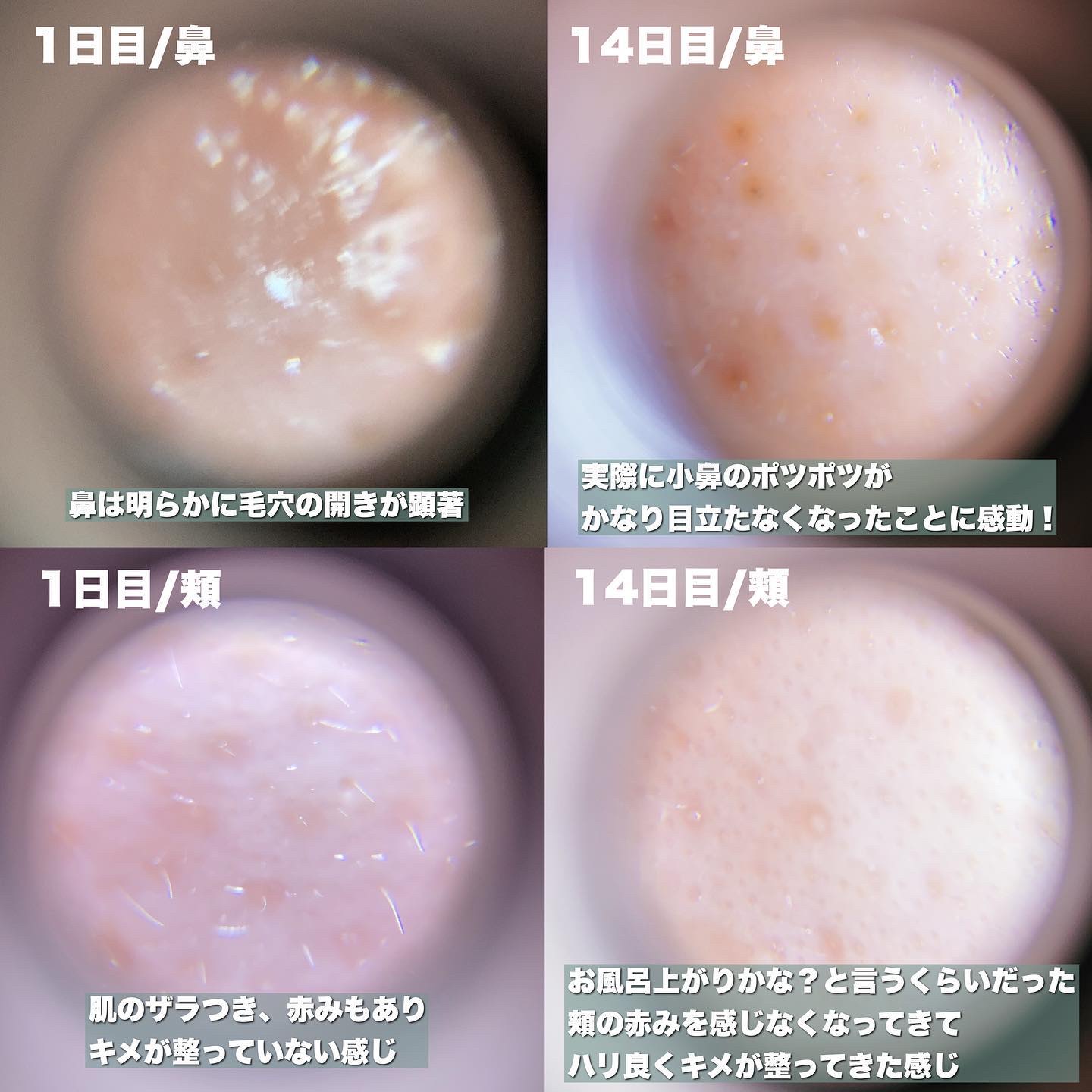 シカレチA クリーム0.05/VT/フェイスクリームを使ったクチコミ（3枚目）
